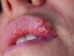  (Herpes simplex)